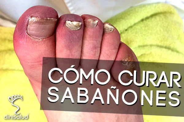 Cómo curar sabañones Podólogo Albacete Clinisalud