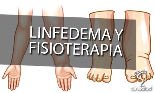 Linfedema y Fisioterapia Albacete