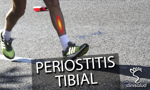 Periostitis Tibial - Podólogo Albacete