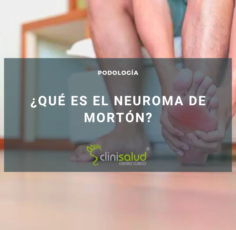 Síntomas del neuroma de Morton