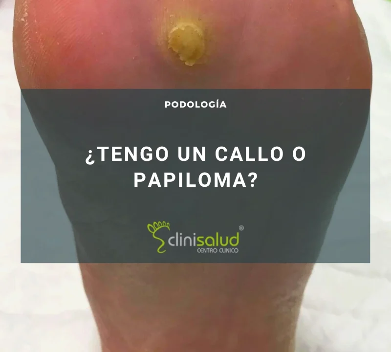 Papiloma en el pie | Clinisalud