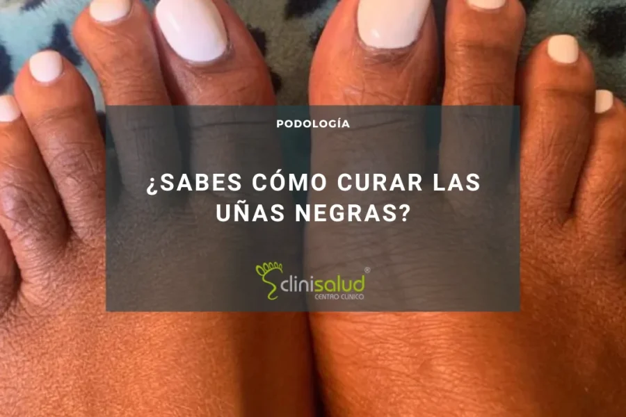 CURAR LAS UÑAS NEGRAS