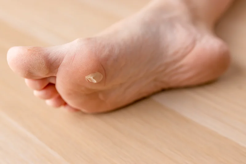 la uña se me clava en el pie