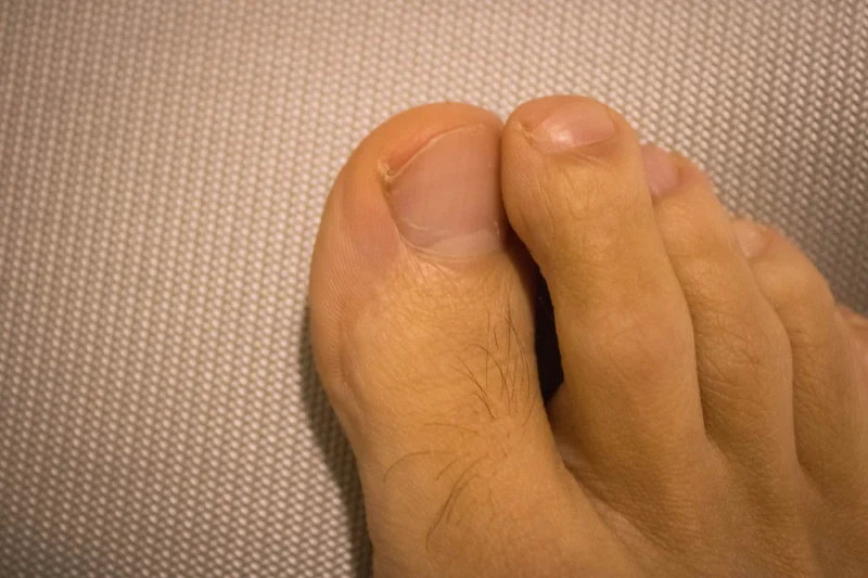 se me clava la uña del pie