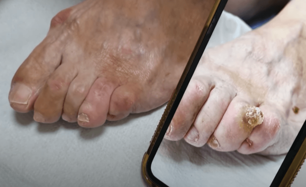 quitar callo con cirugía