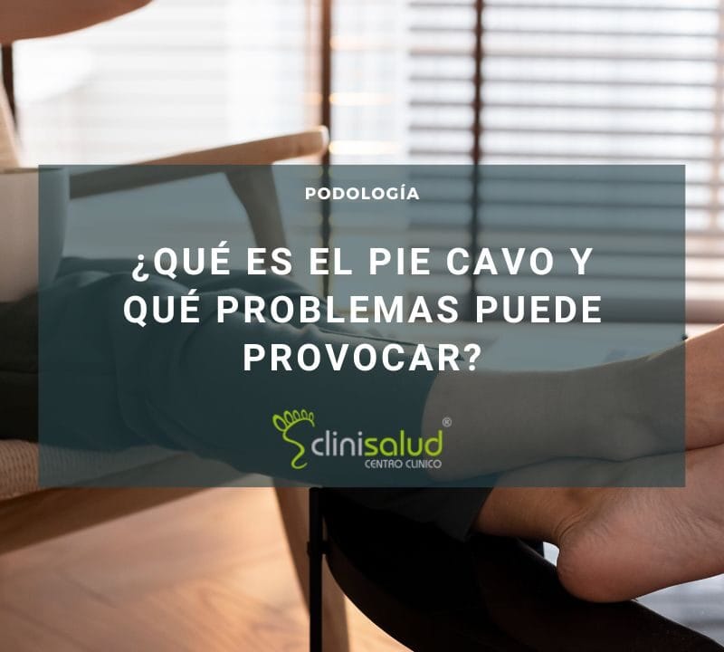 Pie Cavo | Clinisalud