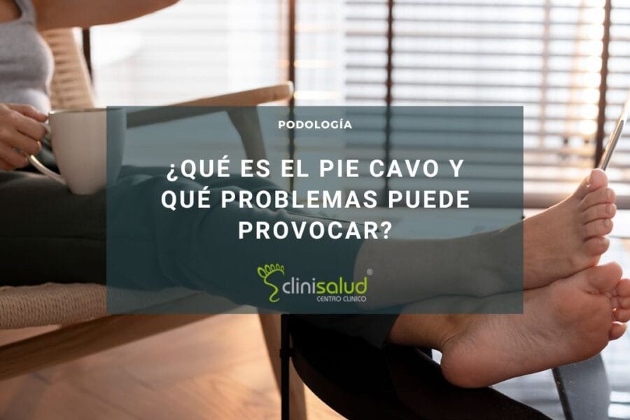 Pie Cavo | Clinisalud