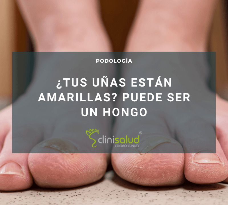 Tengo hongos en los pies