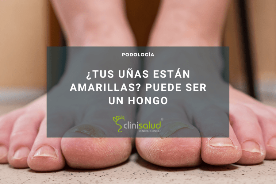 Tengo hongos en los pies