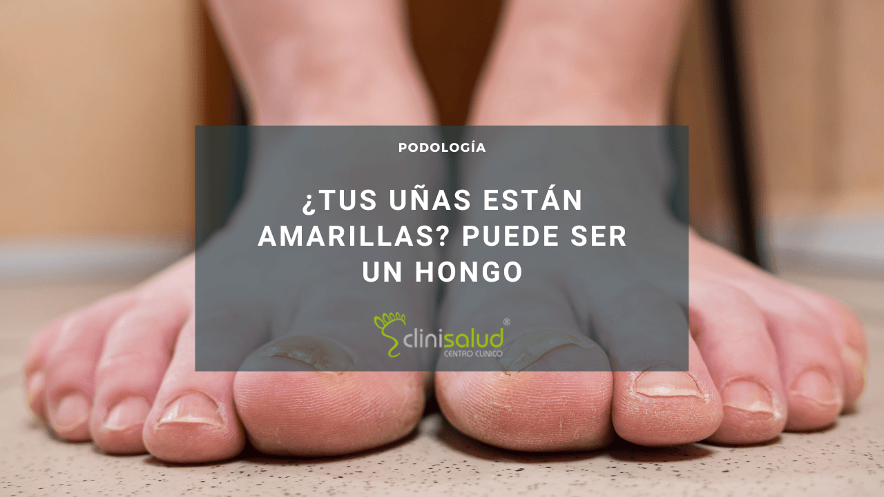 Tengo hongos en los pies