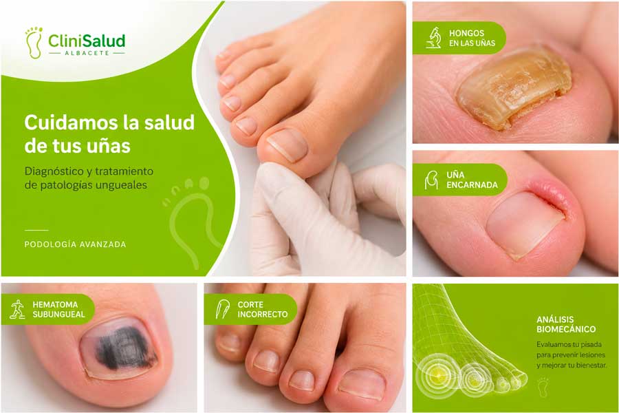 tratamiento de uñas en Albacete
