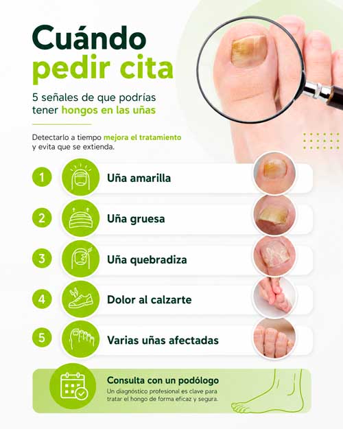 5 motivos para pedir cita al podólogo por onicomicosis