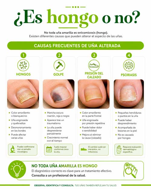 ¿Es hongo o no? Diagnóstico de onicomicosis en los pies