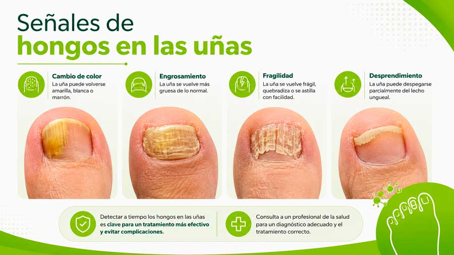 Síntomas de que tienes onicomicosis u hongos en las uñas