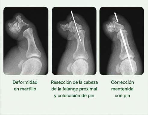 artroplastia de resección en Albacete
