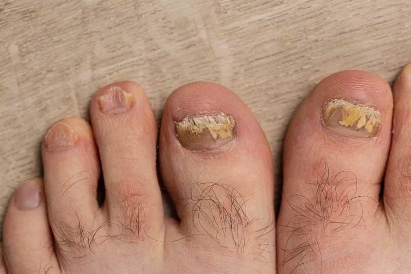 onicomicosis y uñas de los pies amarillas