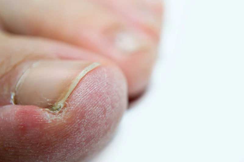 Hongos en las uñas de los pies. Pide de paciente real con hongos