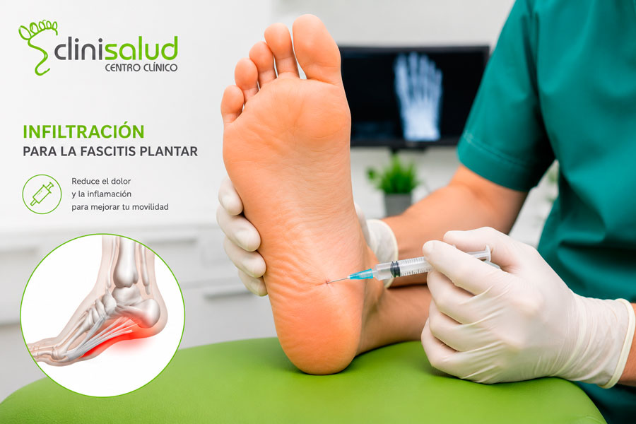 Tratamiento de la fascitis plantar con infiltraciones de prp, corticoides, etc