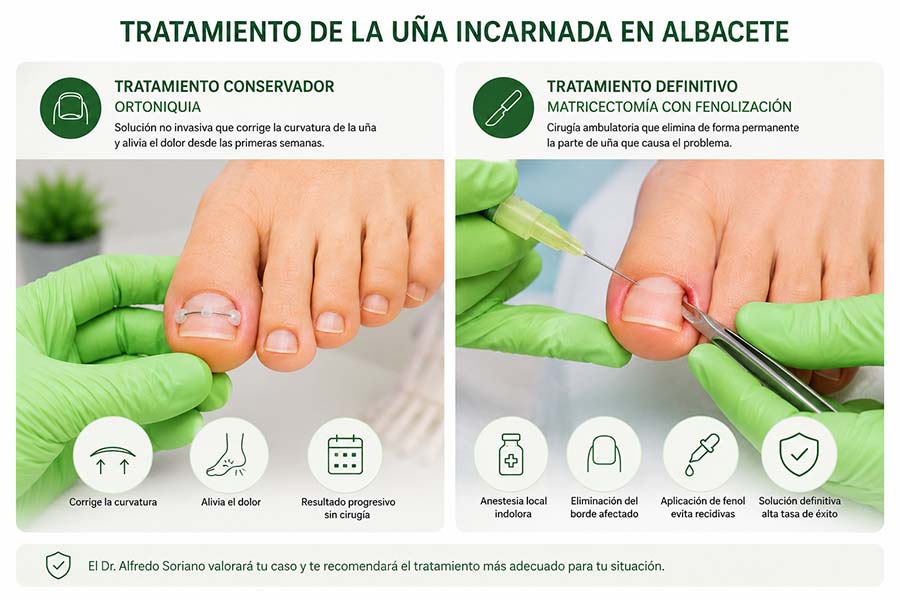 Tratamientos de la uña incarnada en Albacete
