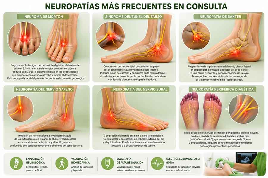 Neuropatías del pie y tobillo en Albacete: neuroma de Morton, túnel del tarso, neuropatía de Baxter, nervio sural y neuropatía diabética