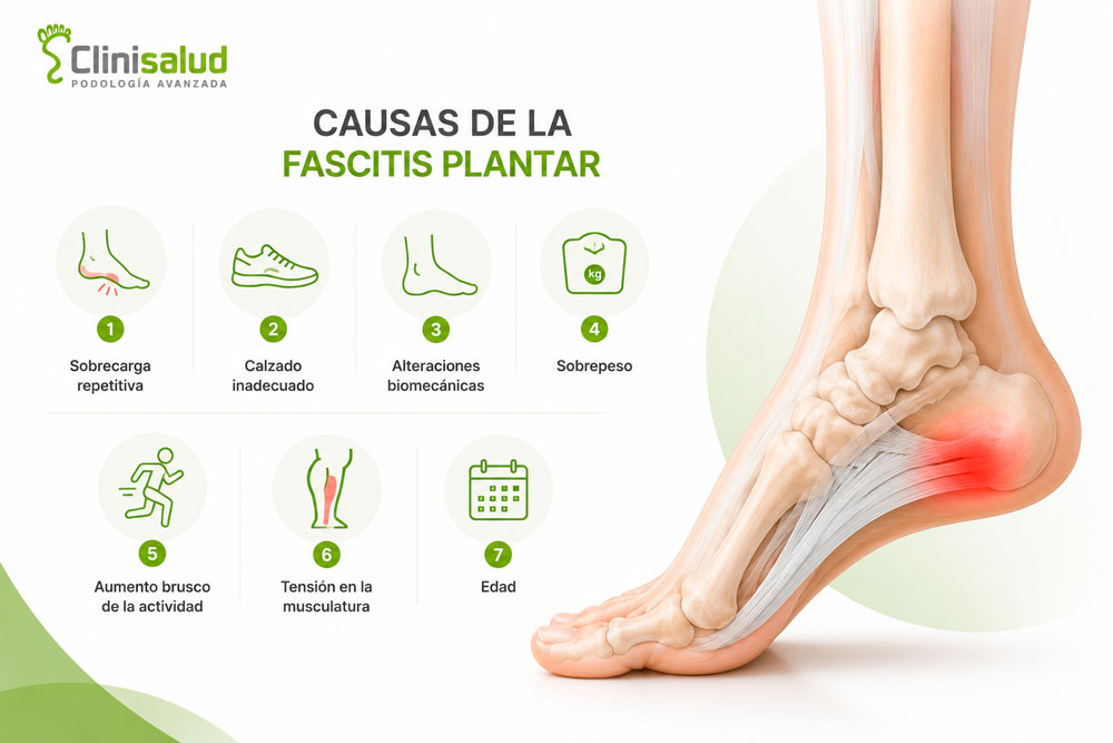 Causas de la fascitis plantar explicadas por el Dr. Alfredo Soriano, de Clinisalud, clínica podológica en Albacete