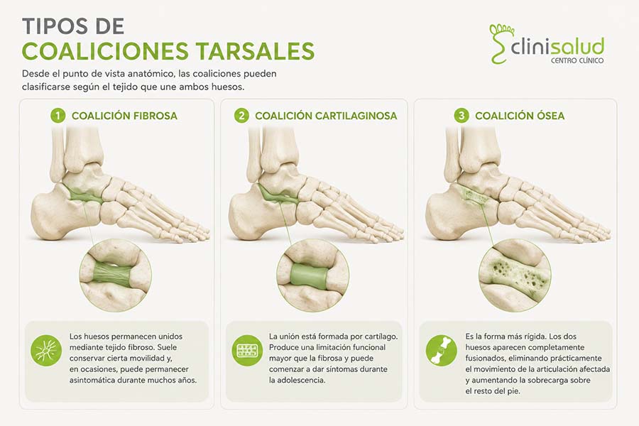 Tipos de coaliciones tarsales: coalición fibrosa, cartilaginosa y ósea representadas mediante ilustraciones anatómicas del pie.