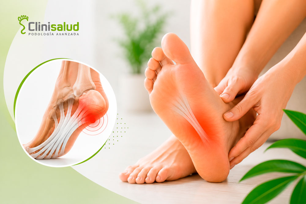 Si eres corredor o deportista y sufres dolor en la planta del pie o el talón, podrías estar padeciendo de fascitis plantar