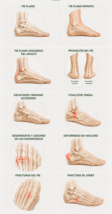 Infografía de las principales lesiones óseas y articulares del pie tratadas en CliniSalud Albacete: pie plano, pie plano infantil, pie plano adquirido del adulto, pronación del pie, escafoides tarsiano accesorio, coalición tarsal, sesamoiditis, deformidad de Haglund, fracturas del pie y fractura de Jones.