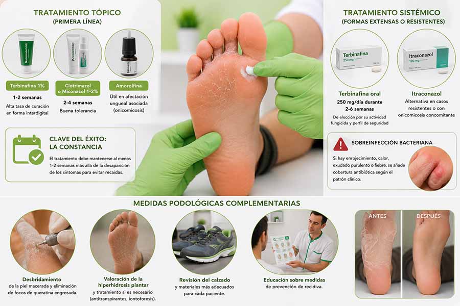 Podólogo aplicando tratamiento sobre un pie con pie de atleta junto a diferentes opciones terapéuticas como antifúngicos tópicos, tratamiento oral, desbridamiento y medidas preventivas para evitar recaídas.