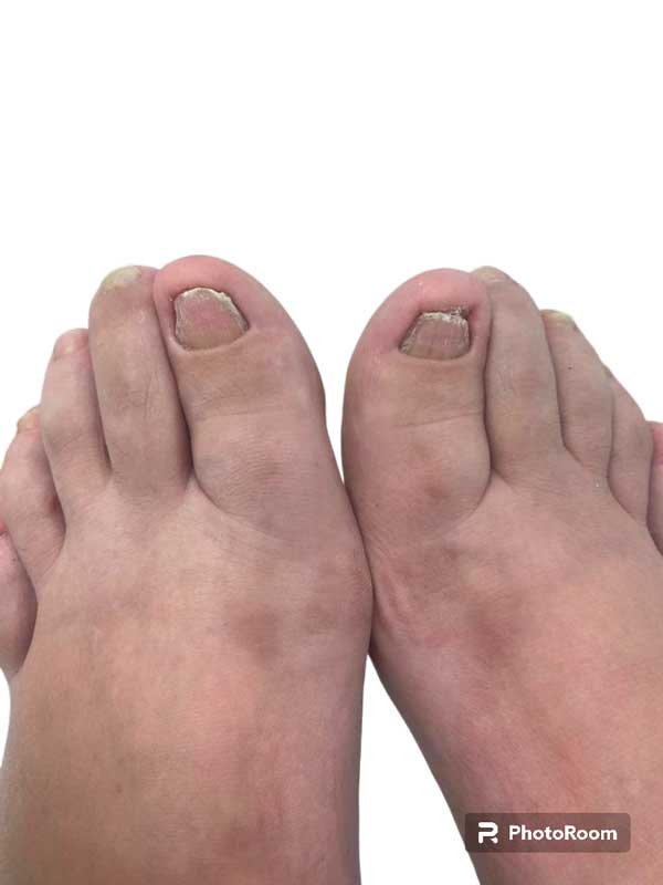 despues del tratamiento de hongos en las uñas de los pies Paciente tratado y curado de hongos en las uñas de los pies. Resultados del tratamiento de hongos en las uñas de los pies en Clinisalud, en Albacete