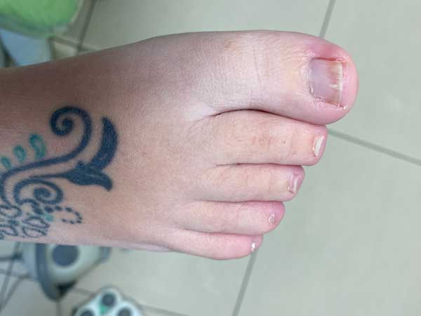 resultados del tratamiento de hongos en las uñas de los pies Paciente tratado y curado de hongos en las uñas de los pies. Resultados del tratamiento de hongos en las uñas de los pies tratados por el Dr. Alfredo Soriano Clinisalud, en Albacete