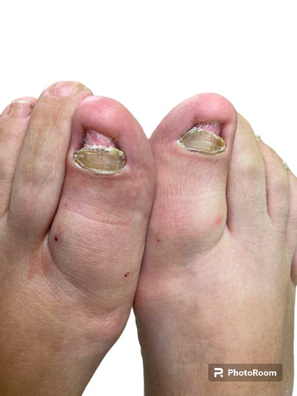 Paciente con hongos en las uñas de los pies Paciente tratado y curado de hongos en las uñas de los pies. Imagen real antes del tratamiento