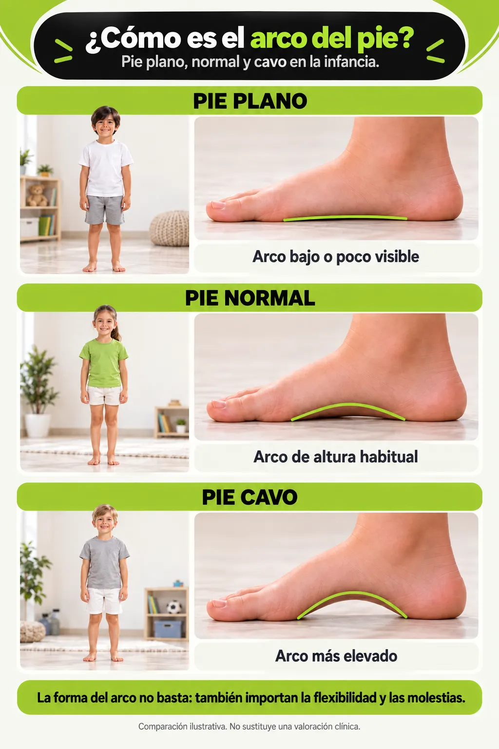 Comparación ilustrativa del pie plano, el arco de altura habitual y el pie cavo durante la infancia.