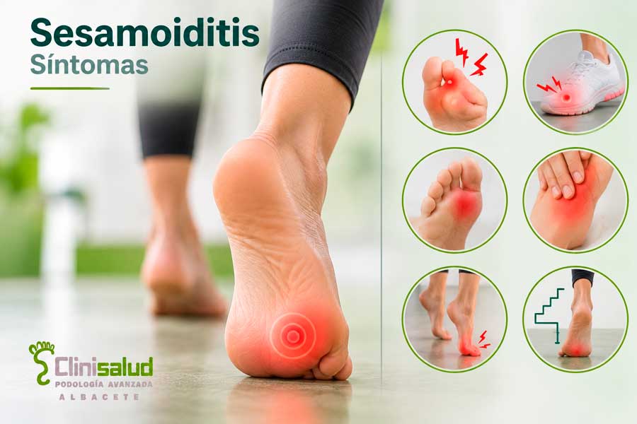 Infografía de síntomas que orientan al diagnóstico de sesamoiditis en Albacete, Clinisalud