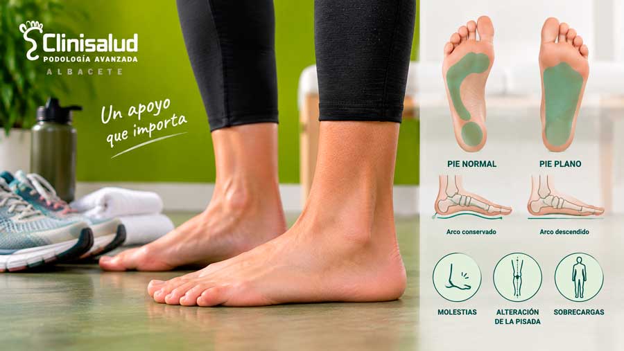 Infografía que compara un pie normal con un pie plano y muestra el descenso del arco, molestias, alteraciones de la pisada y sobrecargas