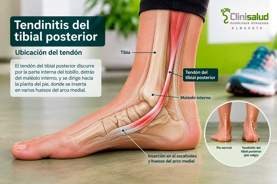 Infografia clinica sobre tendinitis tibial posterior