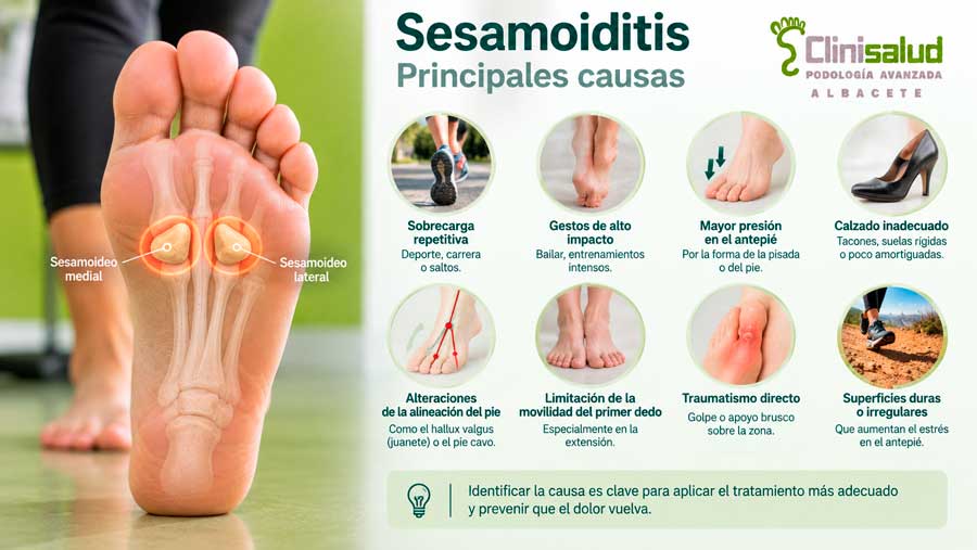 Infografía de causas de sesamoiditis y medidas para reducir la sobrecarga del antepié