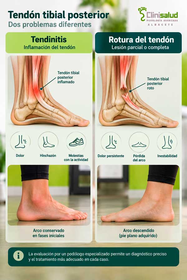 Tendon tibial posterior tendinitis y rotura