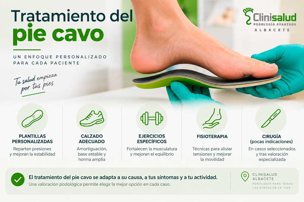 Infografía sobre plantillas, calzado, ejercicio, fisioterapia y cirugía para el pie cavo