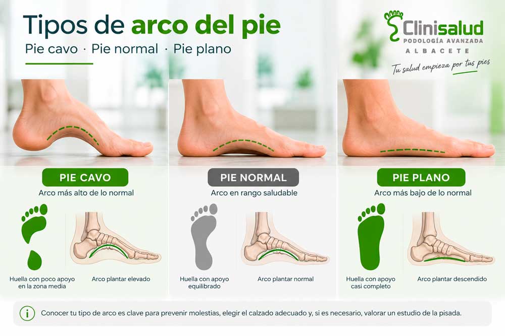Comparativa visual entre pie cavo, pie con arco habitual y pie plano