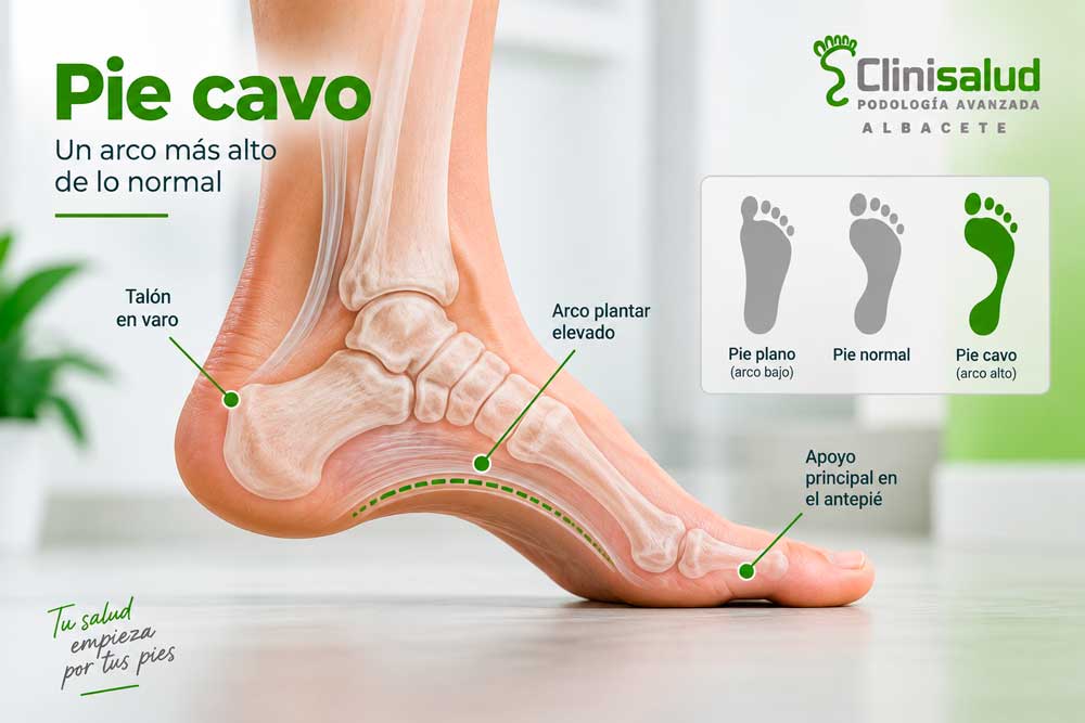 Infografía del pie cavo con arco plantar elevado y mayor apoyo en talón y antepié